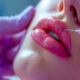 Apa Itu Baby Botox? Solusi Wajah Awet Muda Tanpa Kaku