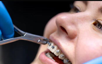 Behel Self Ligating: Solusi Kawat Gigi Modern yang Nyaman dan Cepat