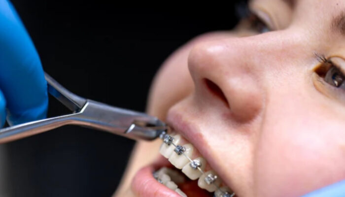 Behel Self Ligating: Solusi Kawat Gigi Modern yang Nyaman dan Cepat