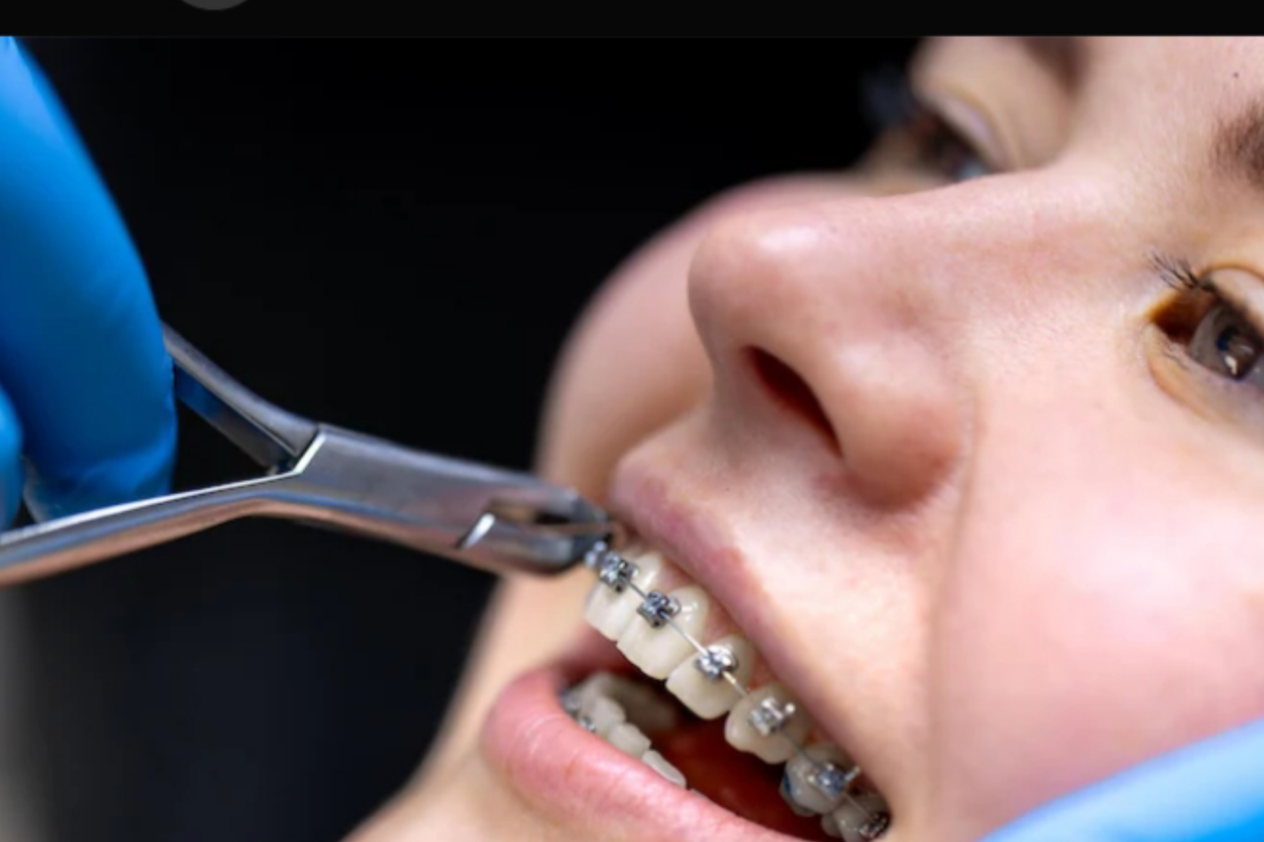Behel Self Ligating: Solusi Kawat Gigi Modern yang Nyaman dan Cepat