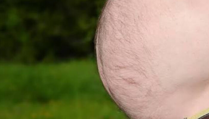 Bukan Cuma Ganggu Penampilan! Perut Buncit Beer Belly Ternyata Simpan Ancaman Penyakit Mematikan