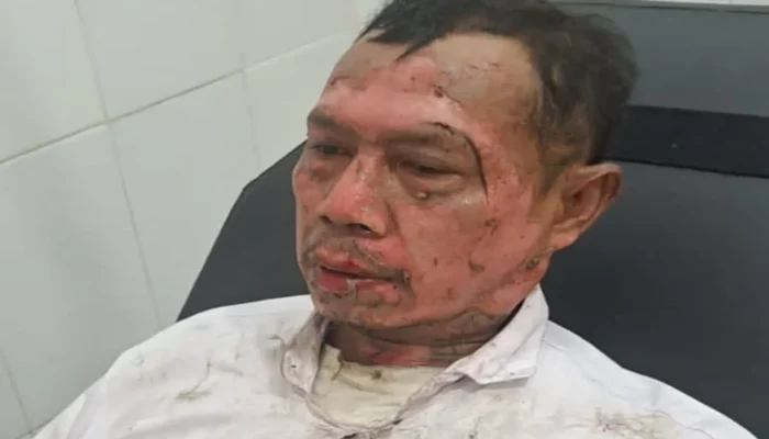 Pawai Obor Tahun Baru Islam di Purwakarta Makan Korban, Peserta Alami Luka Bakar Serius Saat Atraksi Sembur Api