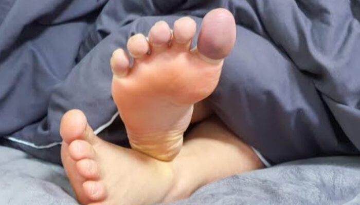 Penyebab Jamur Kaki Sering Muncul